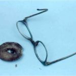 Spectacle Mounted Orbital Prosthesis