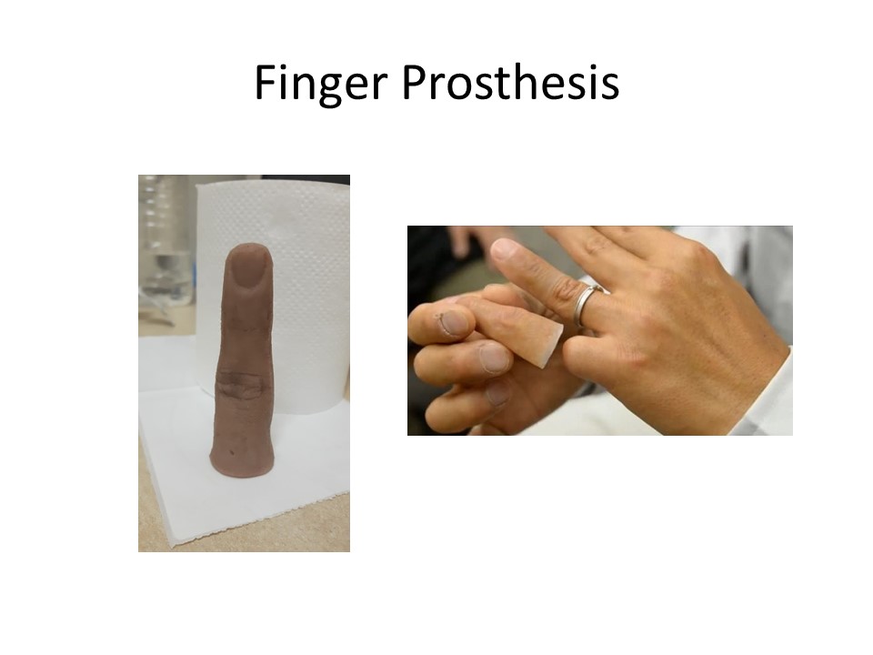Finger prosthesis