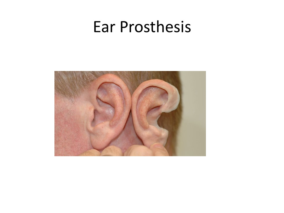 Ear prosthesis