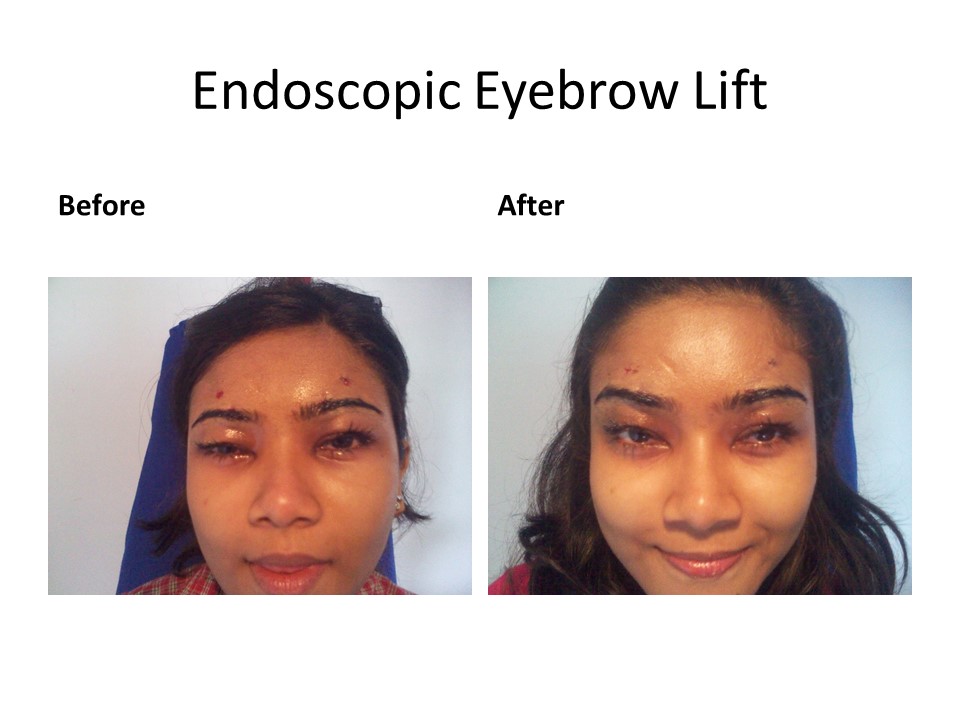 Endoscopic eyebrow