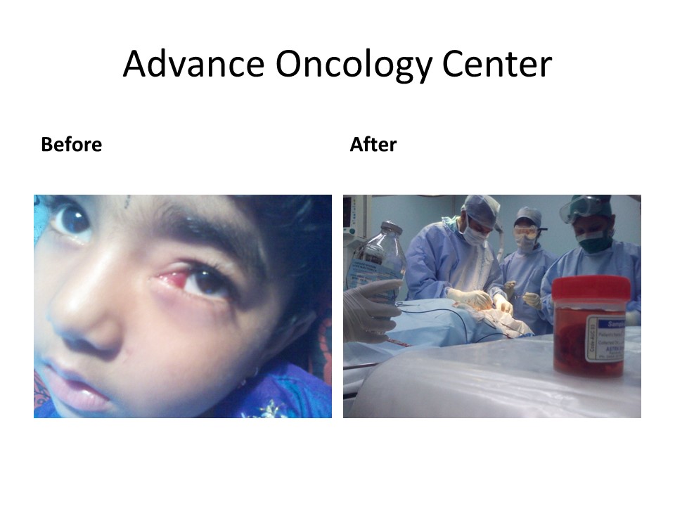 Advance oncology