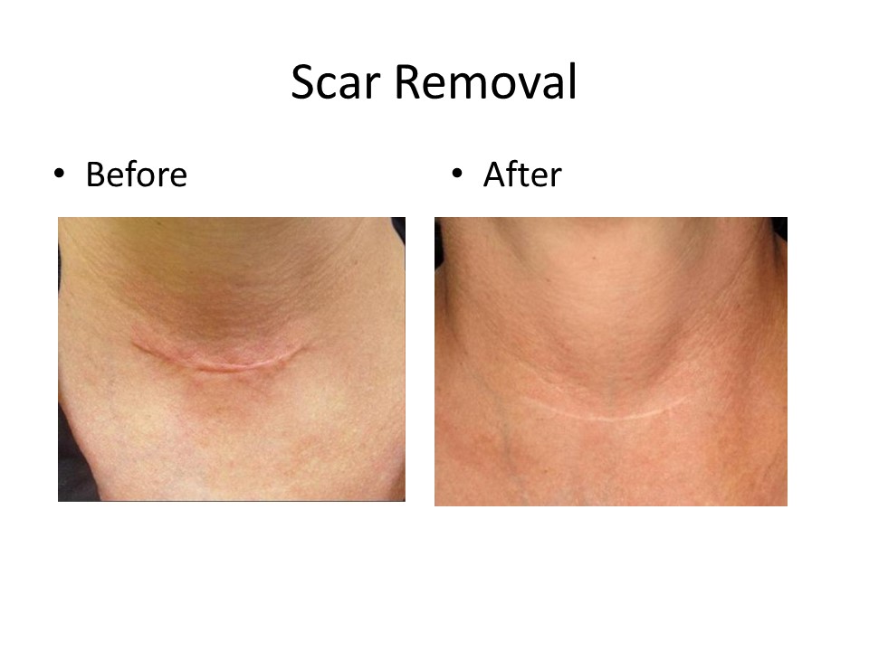 Scar removal