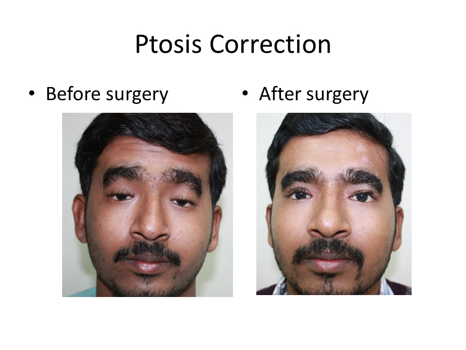 Ptosis correction